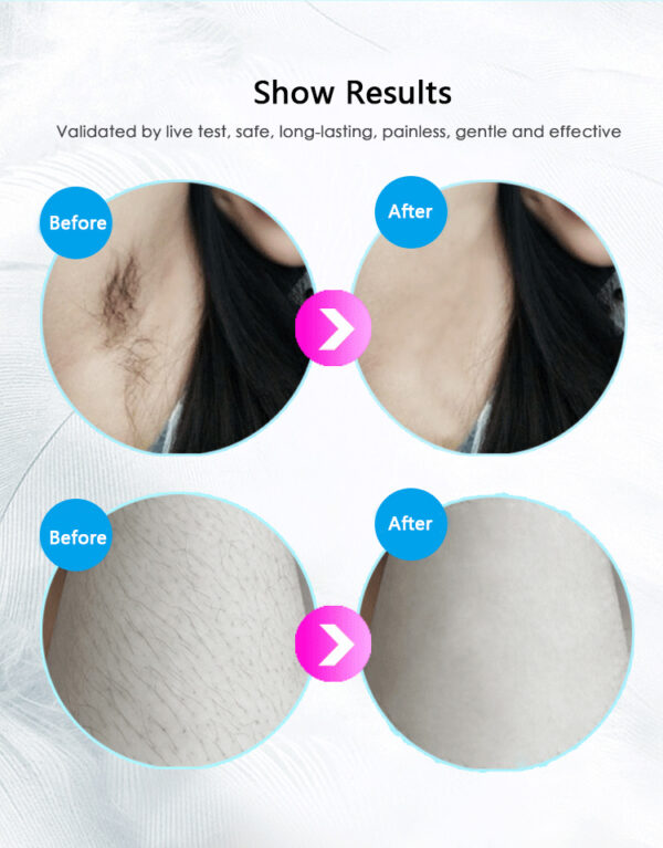 Laser Hair Removal Equipment - Image 9